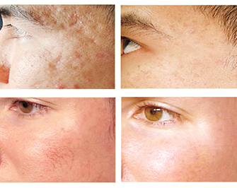 UltraFrax RF Radiofrekwencja mikroigłowa frakcyjna dostępna w Salonie Apogeum